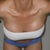 6 weeks post op - bent over front view