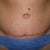 6 weeks post op - tummy tuck close up