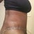PO Day 15 - Rt side