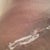 PO Day 15 - Drain wound healing