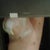 6 days post op