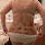 super bruised back!!! and had no lipo there!