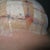 Day 9, Right under...the stitches I pulled.