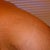 inner boob scarring left side