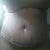 Front view of stomach and that red mark next to my belly was from the day they put me in the garmet. I didn't bring a under shirt and it rubbed me on the ride home. It was worse, so ladies bring under shirt 2nd post op appointment for TT!