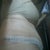 Right side and my TT is an extended. IU asked him why he went so far back and he said in order to get more of my stomach of he had too and I trust him so just gotta deal with what was delt to me.