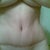 6 WEEKS AFTER (Scar)