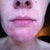 I hope I don't make anyone throw up.. this is how my chin look 2 weeks prior to treatment