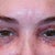 The first day.  My main procedure was CO2 laser of upper and lower eyelid, but he spot lasered small spots on my face too.