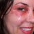 Second day, I look like I'm wearing a Mardi Gras Mask, or Star Trek. Spot lasering on face too.