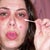 The skin is so raw it has little cracked bleeding areas.