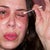 The skin is so raw it has little cracked bleeding areas.