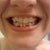 you can easily see where I'm missing my bottom teeth under the pontics. It isn't typically visible when I talk or smile tho.