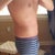 2 weeks post op