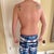 2 weeks post op