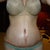 3 Weeks post op