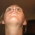After revision - 8 weeks post-op