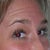 BEFORE BOTOX