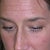 BEFORE BOTOX