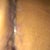 Scar scabs OUCH, 2 wks PO