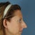 Here is a "before" photo taken at my doctor's office.  You can see my nose was very large.  I just want to have a nose that doesn't get as much negative attention.