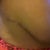 Close up of high scar side - 4.5 mos PO - not sure if this is swollen or my result. The scar is kinda think and sore