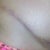 High scar - right side
