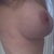 side view 6 months post op