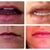 Here's an easy side by side to see. Left pics are before. Right top is of 24 hours after surgery and right bottom is 5 days after surgery. Hope it helps!