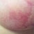venous congestion causing red/blue bruised appearance