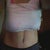 1 month post op
