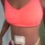 after side view no more stretch marks or hanging skin im happy! pod 2
