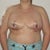 Two days post op.