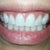 Almost a year later.  Still wearing my Invisalign retainers at night.