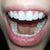 I also had my dentist even out the length of my 2 front teeth.  I'm very pleased!