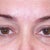3 months after injection.  Do you see the permanent dark mark in the injection crease?