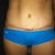 Scare at 5 1/2 months post op