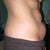One month before procedure