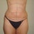 This is one day after the procedure