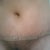 Close up. Sorry. :) The puckering on my left side is almost gone, just as my PS said to would. The incision is still covered under the steristrip. It is long, but low and I love it. Bonus was that my PS removed some of the hair-bearing skin! Ha! Complimentary hair removal! :)