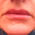 Day 7 - Devastated by size of top lip, she shape & unsure if overfilled or still swollen :(