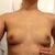 Post-op day 3