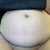 My surgeon's practice marks for my incision!