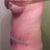 Day 21-Woke up feeling flatter. Still bruised on flanks from lipo and still swollen below bb-little back fat