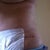 week 4 post opside of scar that you can see
