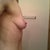 side view pre-op