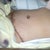 One day post-op