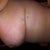 Side view. 19 days post op!