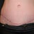 4 months post op