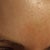DAY 16 - forehead.  This is the area with the worst track lines, hyper pigmentation, and you can also see the texture which is kind of like an orange peel.  Hope with how proactive I am being now in light of this, I will be able to post a new photo in a few weeks showing this healed and filled in.